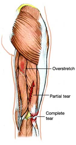 Overstretch partial and complete tear