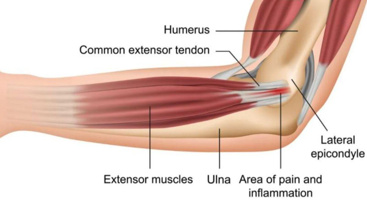 What Causes Tennis Elbow or an Extensor Tendinopathy?