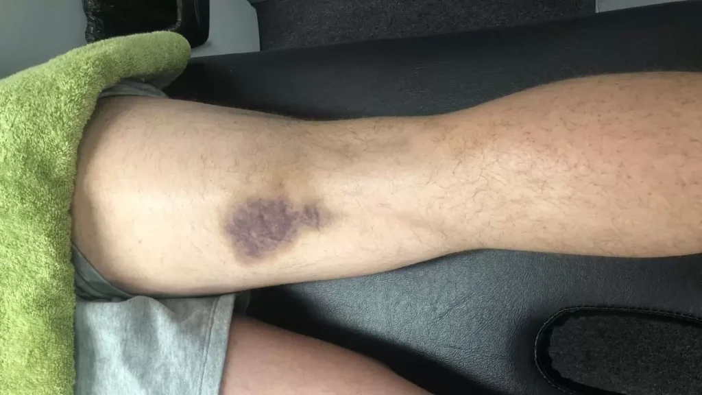 Hamstring injury