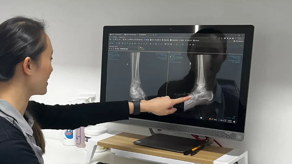 Diagnosis of navicular stress fractures