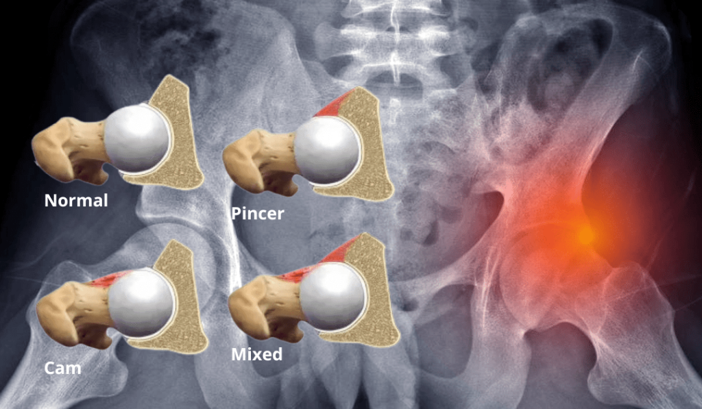 Hip Impingement