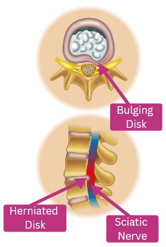 Bulging disk sciatic nerve
