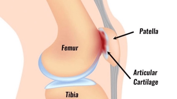 Causes of PFPS