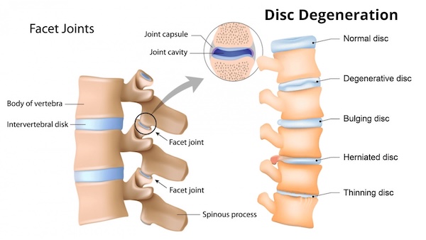 Disc degeneration anatomy