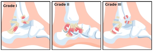 Lateral ankle sprain