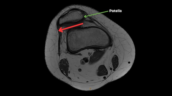 Patella anatomy