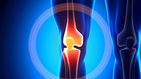 Patella dislocation