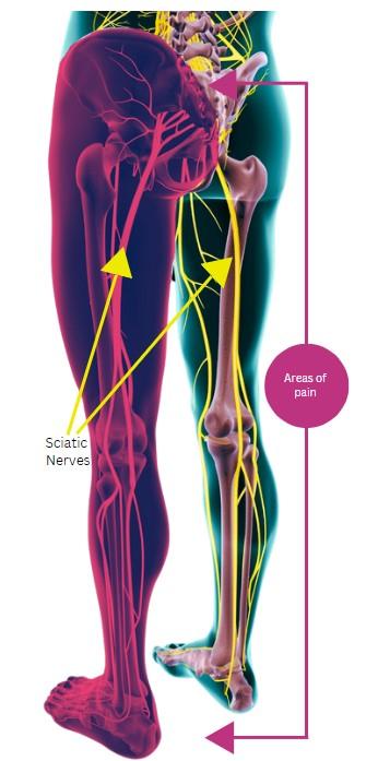 Sciatica anatomy