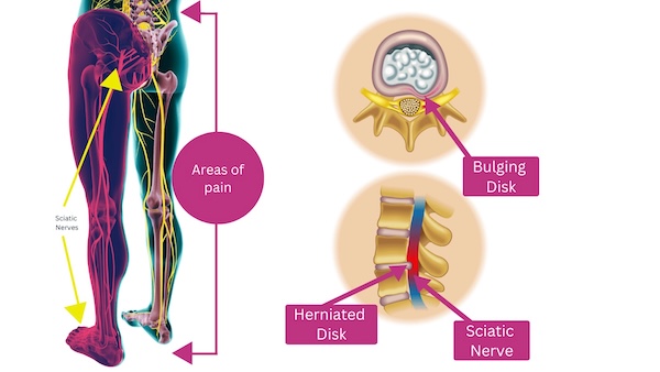 Sciatica representation