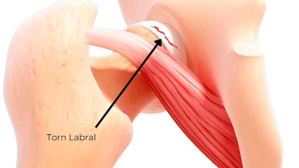 Torn labral anatomy