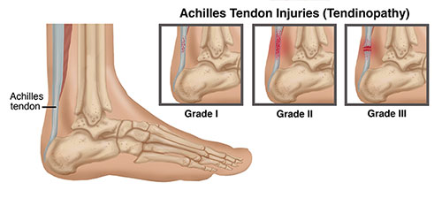 Achilles Tendon Injury Anatomy