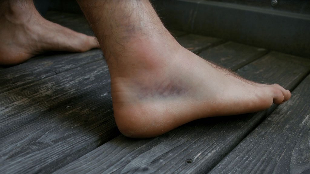 Bruised Ankle