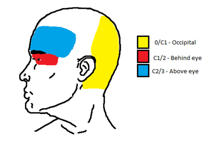 Cervicogenic headache