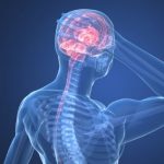 Cervicogenic headaches