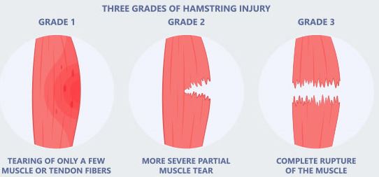 Hamstring tears anatomy