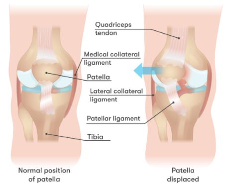 Patellar dislocation anatomy