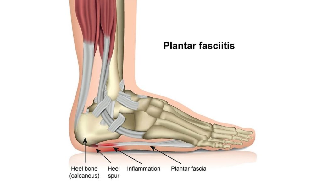 Plantar Fasciopathy Anatomy