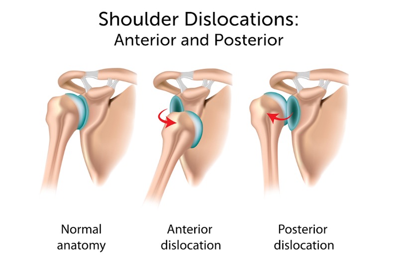 shoulder dislocation
